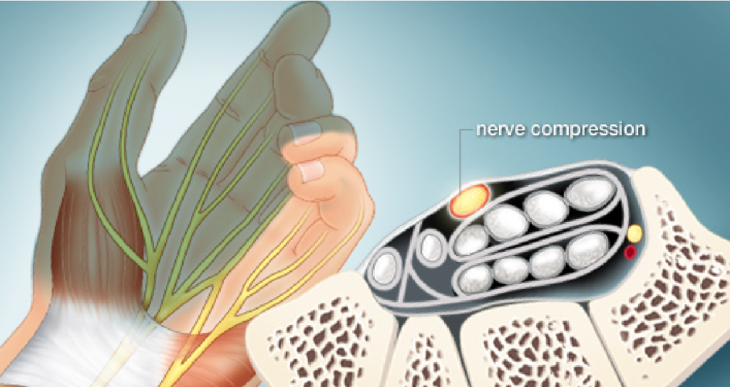 WebMD's tweet photo. If you have carpal tunnel syndrome, your doctor may recommend wearing a brace or splint at night. Here's why: https://t.co/f9KZLRMPjp https://t.co/1Nw92hZHCu