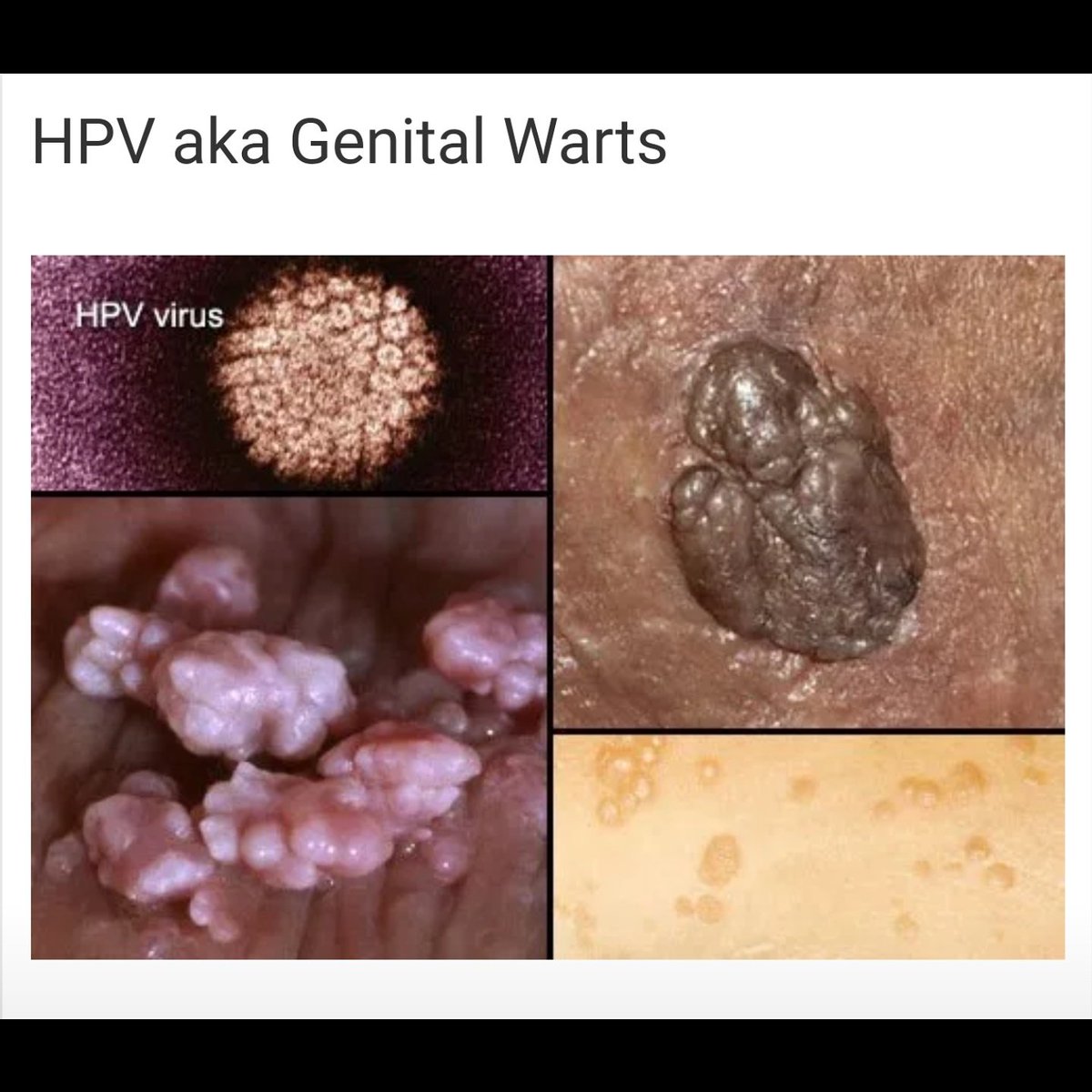 hpv wart bleeding la adulți  simptome de helminți la om