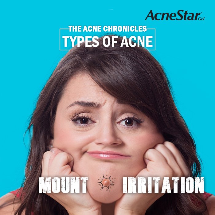 AcnestarGel's tweet photo. Acne Chronicles #1
Mount Irritation is caused by hormonal imbalances. Relax and de-stress to avoid these!
#acnechronicles #typesofacne #acne https://t.co/iSLtA3HBoO