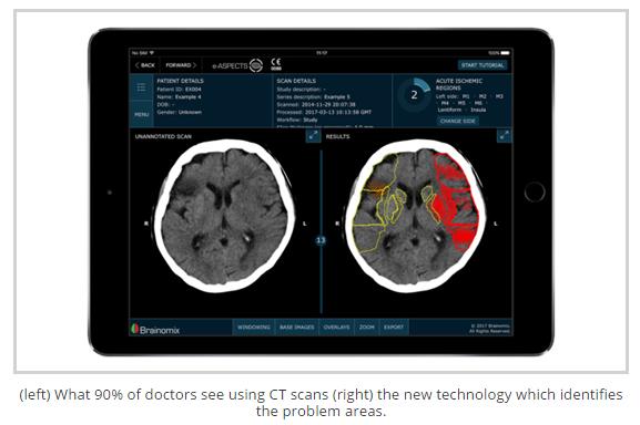eComputerZ's tweet photo. @Brainomix e-Aspects #AI helping CT Consultants decide on stroke victim treatment within 2 minutes. Fantastic!
https://t.co/FJBS5oCLuE https://t.co/jEbr1ORxuj