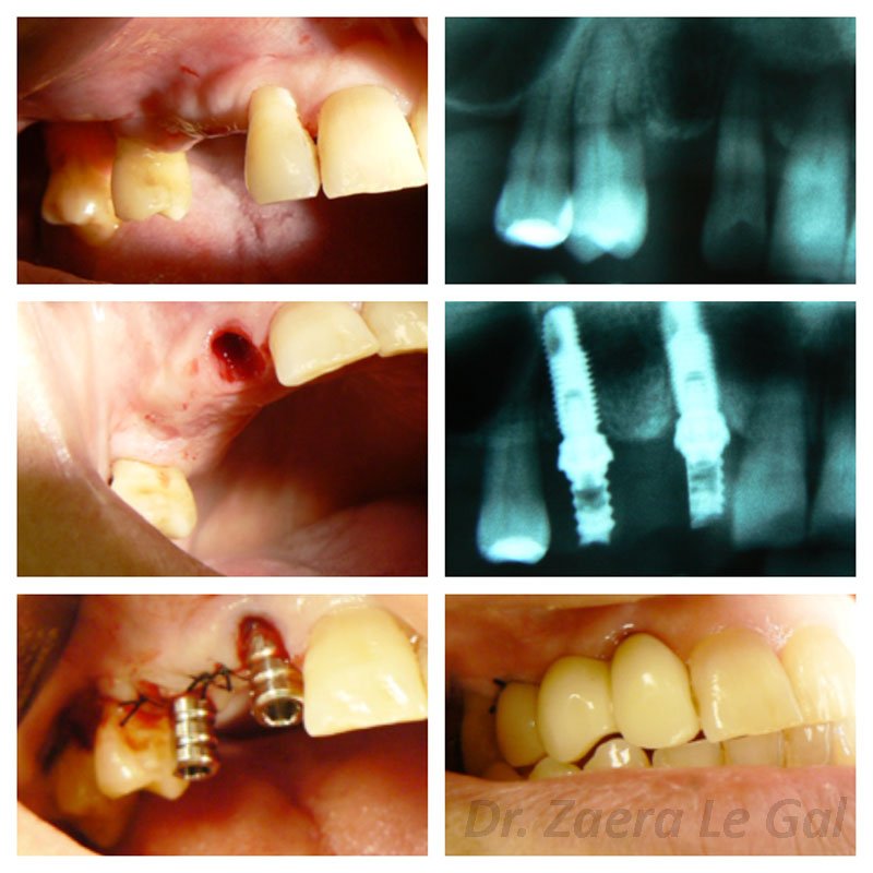 CEIO_Centros's tweet photo. Implantes y dientes en un solo día: Empieza a sonreír 😄 😁 😆
➡ Caso clínico llevado a cabo por el Dr. Zaera Le Gal ⬅
https://t.co/wtBXUVzsLM https://t.co/nWziMP7Sav