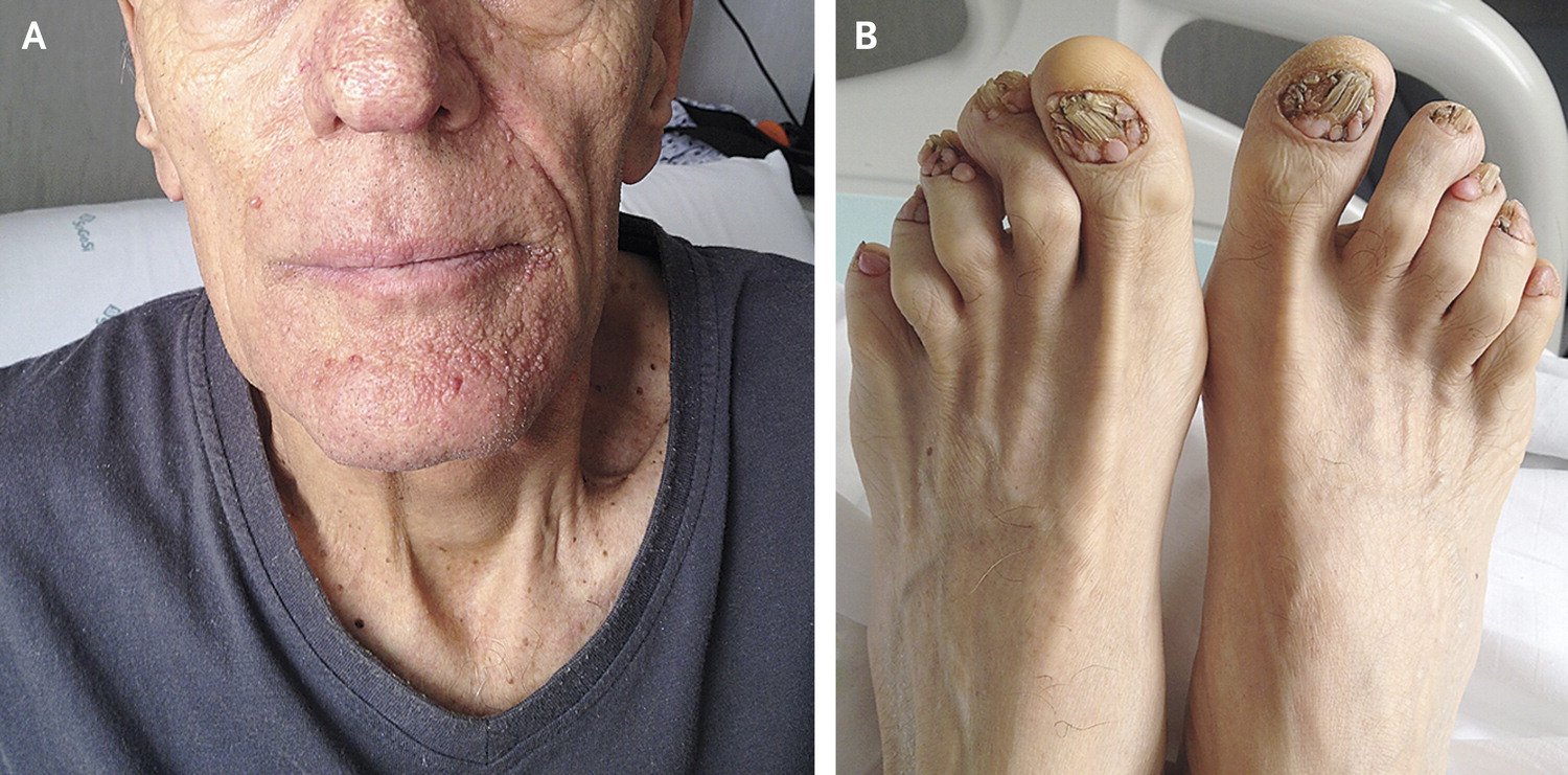 Cutaneous manifestations of tuberous sclerosis in the foot: A case study