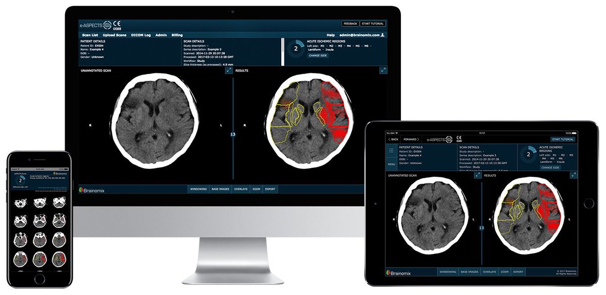 Brainomix's tweet photo. Big news for London stroke sufferers.
Northwick Park Hospital adopts new software to help identify stroke victims  https://t.co/t5pB0qk6zd https://t.co/g16QZip1dc
