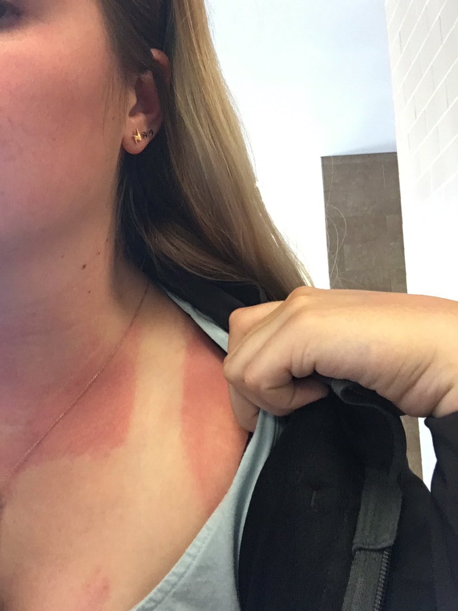 du_crsmith's tweet photo. That Colorado sun really got me.. with sunscreen #classoutside #Writ1133du https://t.co/v4fW9aSbvG
