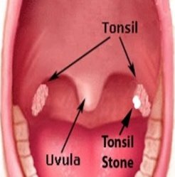 Mariajee's tweet image. Tonsils Stones Treatment, Causes And Prevention - infocentre.co/tonsils-stones…