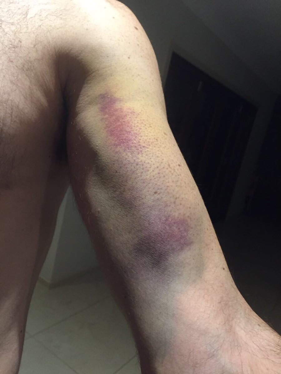 darren_william's tweet photo. Yeah and I don't usually bruise easily #tornpec #mondaysurgery https://t.co/UmYRtNYEsR