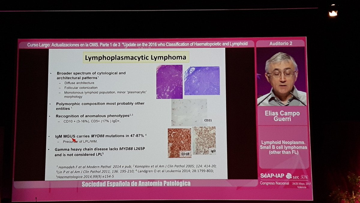 crazylymphocite's tweet image. Other Small B cell lymphomas. Dr. Elias Campo, grate master. #SEAP2017V