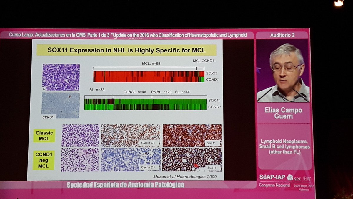 crazylymphocite's tweet image. Other Small B cell lymphomas. Dr. Elias Campo, grate master. #SEAP2017V