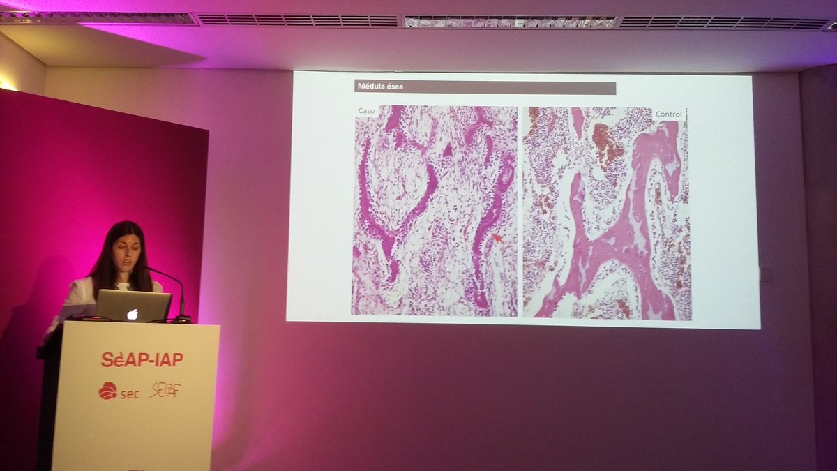 DraEosina's tweet image. Displasias esqueléticas, abordaje multidisciplinar. Excelente presentación de la Dra. Hernández Bonilla. #SEAP2017V  @EJAutopsy