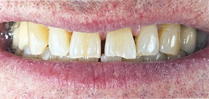 oralthbcn's tweet photo. Tratamiento de desgastes en los #incisivos superiores, o cómo adecuar una #sonrisa a su edad https://t.co/A0I7wOhW6s vía @maxillaris_sp https://t.co/R6y1HUX6ru