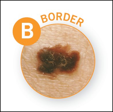 AADskin's tweet photo. Look for the ABCDEs of melanoma when checking your skin. If you see anything suspicious, see a derm. https://t.co/GJaBZuQs8c #SpotSkinCancer https://t.co/C6k2KjxwzR