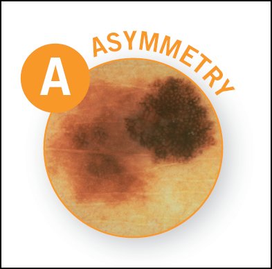 AADskin's tweet photo. Look for the ABCDEs of melanoma when checking your skin. If you see anything suspicious, see a derm. https://t.co/GJaBZuQs8c #SpotSkinCancer https://t.co/C6k2KjxwzR