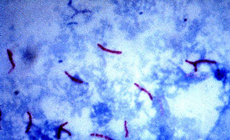 Aids durch Mykobakterien? -> bit.ly/2qPjhsy #gesundheit #aids #mykobakterien