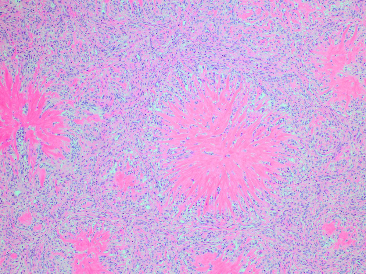 egoebs's tweet photo. Starburst Pattern: Smooth muscle differentiation with central hyalinization in LGESS #Gynpath https://t.co/Lls5xzMFkw