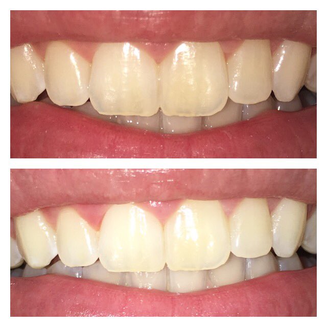 e_nowlin's tweet photo. Let me know if you wanna learn about how to whiten your teeth fast. This is a four day difference for mine! https://t.co/osPAcxjDbG