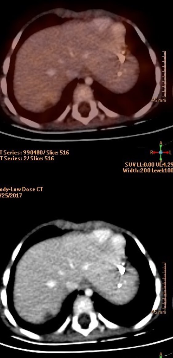 fermgmez's tweet photo. Germinal tumor liver M1, #XPerCT overlay & #XPerGuide: hydrodissection and MWA at the liver dome @SJDbarcelona_es @socpedsir @PhilipsHealth https://t.co/3wc8YeHdSV