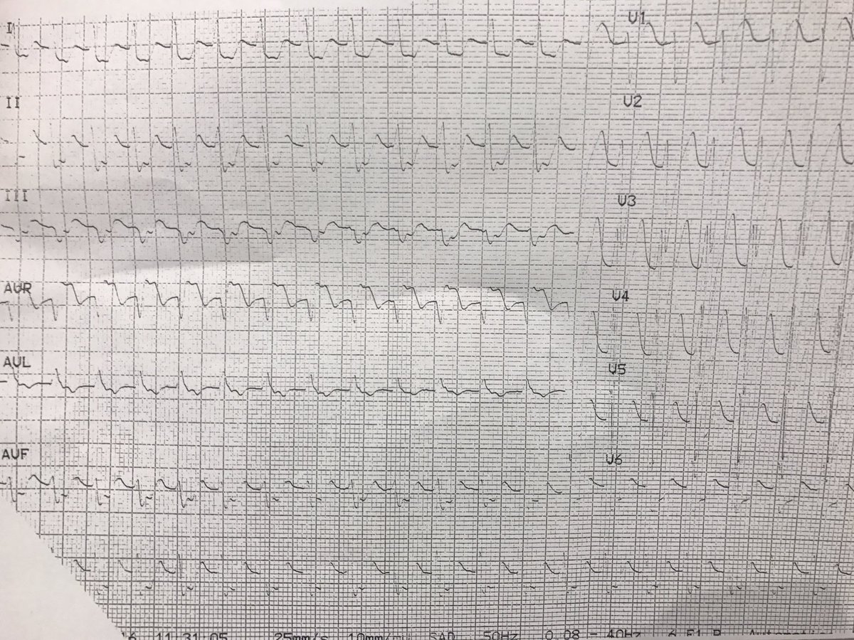 atypicalflutter's tweet image. AVNRT,AVRT or Aflutter?