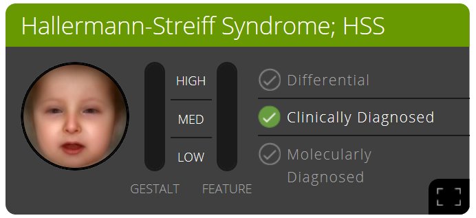 Pedia_Team's tweet photo. In #PEDIA2, we'll use image analysis to identify disease-causing mutations, e.g. for Hallermann-Streiff syndrome. See you at the #ESHG2017! https://t.co/iellPNgeZu