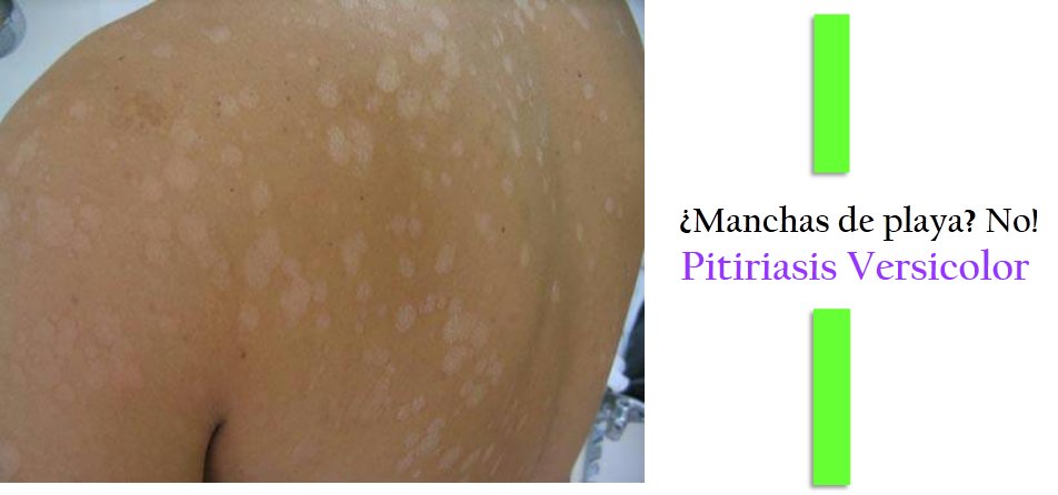 UNIDERM's tweet photo. Es una micosis superficial producida por levaduras del género Malassezia, que aparecen lesiones circulares hiper o hipopigmentadas #UNIDERM🤓 https://t.co/HowkHqQIDX