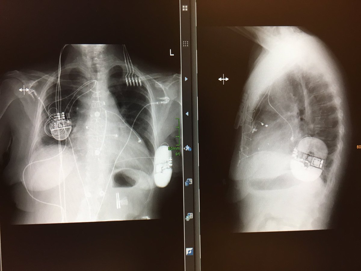 PreOP: endocarditis, destroyed tricuspid valve and TV-ICD; 18% LVF...
PostOP: Tricuspidvalve replacement, epicardial CRT + S-ICD