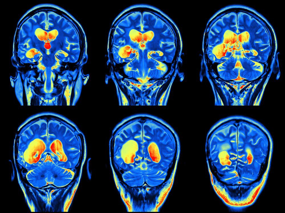 MSNewsToday's tweet photo. CMSC Revises Recommendations for Gadolinium Use in MRIs https://t.co/eDLjCsanaJ https://t.co/gvtMjd2cJQ