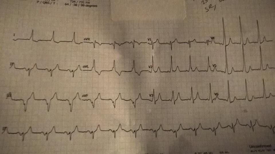 1. Ekg
Düzensiz ritim
Geniş QRS
Taşikardik hız
Delta dalgası = WPW+YVAF

2. Ekg aynı hastanın kardiyoversiyon yapıldıktan sonraki Ekgsi.
