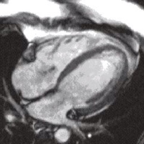 mzkhalil's tweet photo. Together, the papillary muscles and the chordae tendineae are known as the #subvalvular apparatus.
#Mitral_valve
#Cardiology
#ImagingMD https://t.co/fGRXlAc1dh