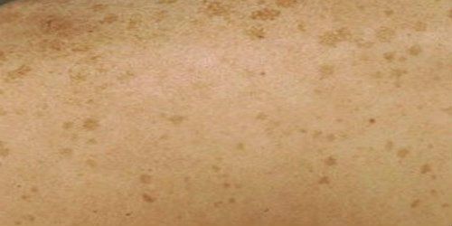 AbsolutelyPure's tweet image. Prevent liver spots and skin ageing naturally with a low PUFA Diet #natural health #skincare #paleo