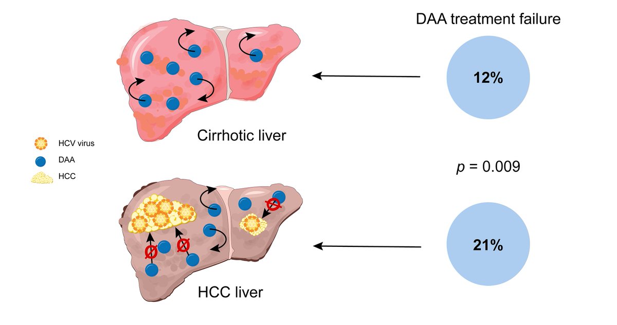 #HCC decreases the chance of successful #HCV therapy with direct-acting antivirals
bit.ly/2kZ0Rny
#cancer #hepatitis #HepC