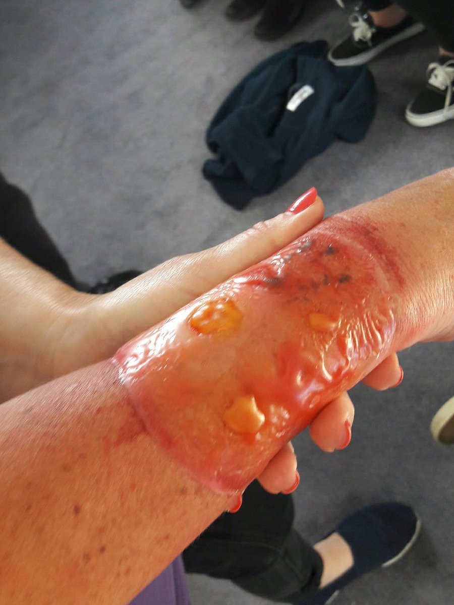 AlexIrvineLeeds's tweet photo. Ouchy! Another unexpected experience talking in group then all of a sudden....
Learning about managing burns
... #SCIP #RAMPPS https://t.co/azg44hj2yT