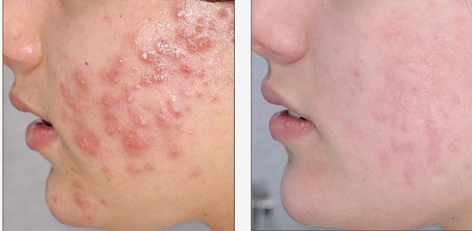 Skins_Solutions's tweet photo. One of our todays very happy customers Amy and the result of an acne scar treatment we've provided her with. Sign up for a visit today https://t.co/McbkEjcPkl