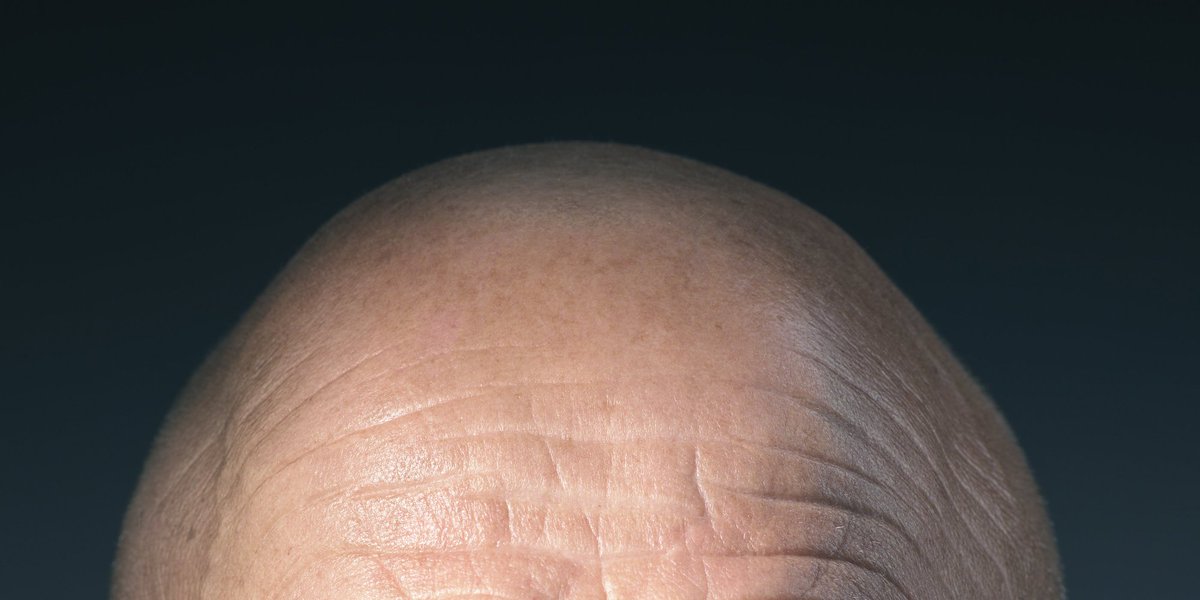 Scientists could develop a treatment for baldness after stumbling on what causes it huffp.st/FJUooht