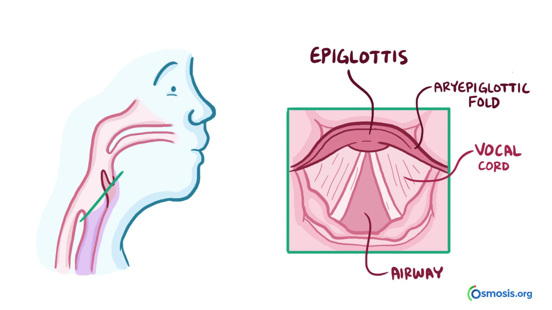 Laryngomalacia Diagram