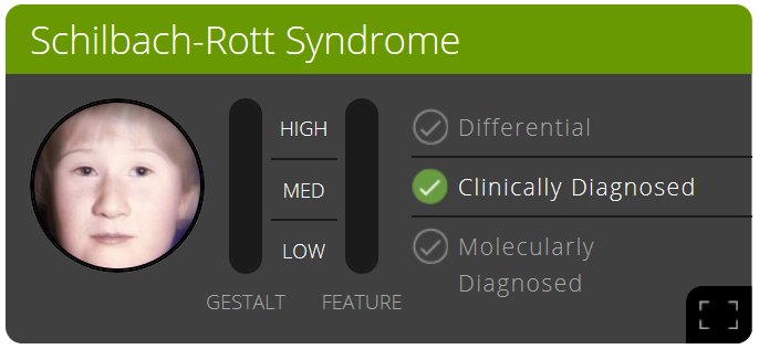 Pedia_Team's tweet photo. 3rd gene to discover with the help of image analysis in #PEDIA2: Schilbach-Rott syndrome.
#ESHG2017 https://t.co/tyhWxNFyVB