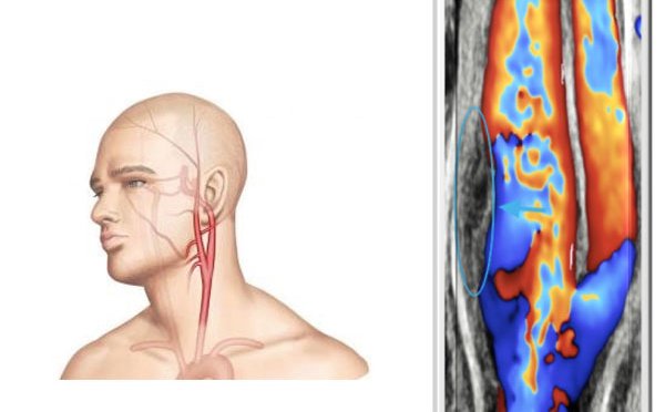 AVC et infarctus : une avancée scientifique pour réduire les risques senioractu.com/AVC-et-infarct…