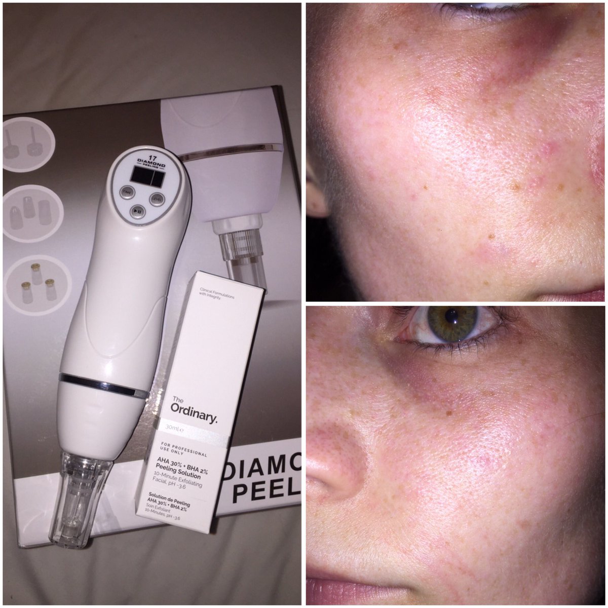 CharliCarter_'s tweet photo. Got hold of a Diamond #Dermabrasion machine and The Ordinary AHA/BHA #skin #peel here's immidiatly after #treatment :-
@deciem @Ddskinlove https://t.co/zBVfcQBzIc