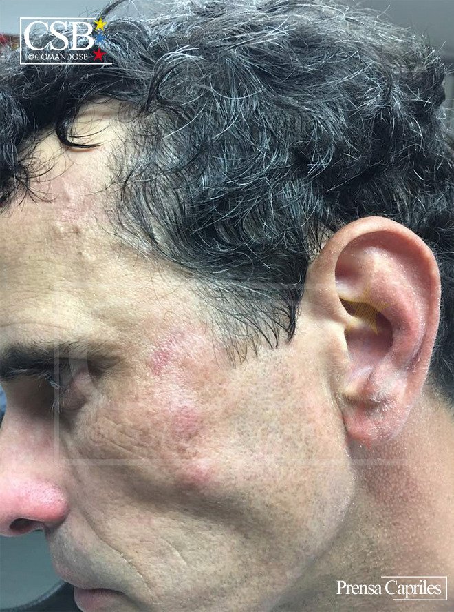 AlbertoRodNews's tweet photo. ÚLTIMA HORA | FOTOS - Así quedó Henrique Capriles tras el ataque de la GNB en Las Mercedes: Le metieron con un casco en la cara #29May https://t.co/PWwW3LPLKp