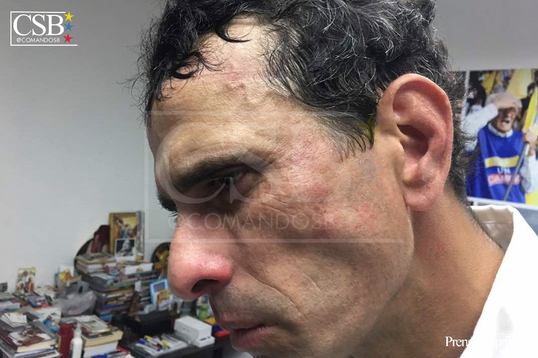 AlbertoRodNews's tweet photo. ÚLTIMA HORA | FOTOS - Así quedó Henrique Capriles tras el ataque de la GNB en Las Mercedes: Le metieron con un casco en la cara #29May https://t.co/PWwW3LPLKp