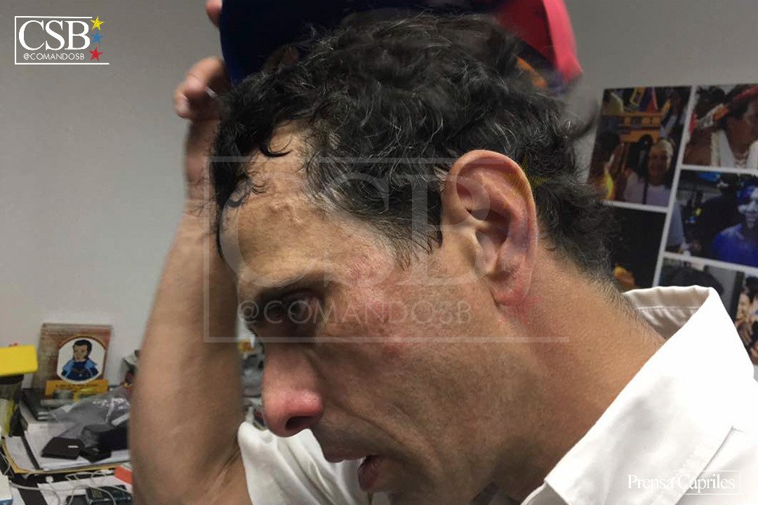 AlbertoRodNews's tweet photo. ÚLTIMA HORA | FOTOS - Así quedó Henrique Capriles tras el ataque de la GNB en Las Mercedes: Le metieron con un casco en la cara #29May https://t.co/PWwW3LPLKp