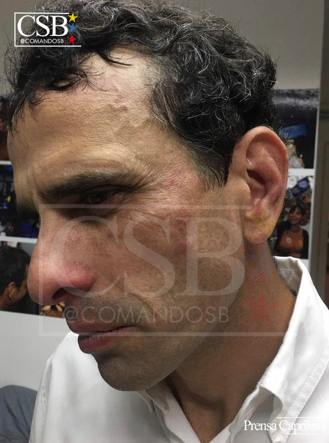 AlbertoRodNews's tweet photo. ÚLTIMA HORA | FOTOS - Así quedó Henrique Capriles tras el ataque de la GNB en Las Mercedes: Le metieron con un casco en la cara #29May https://t.co/PWwW3LPLKp