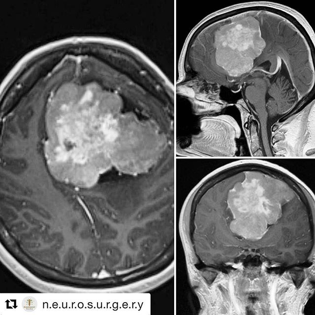 neuro_oncologia's tweet photo. What type of tumor is this?. #medicalschool #instamedic #neurocirurgiabr #neurosurgeryblog #neuroradiology… https://t.co/t6YkigMqiW https://t.co/AnDzAxeLeV