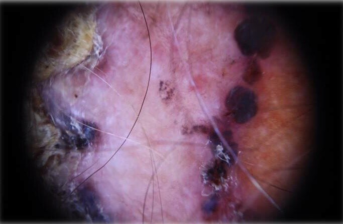 youdermoscopy's tweet photo. Man, 68 years old, lesion located on head
In the next few days we'll publish the correct diagnosis
#dermoscopy #skin https://t.co/QCVWUTD7eK
