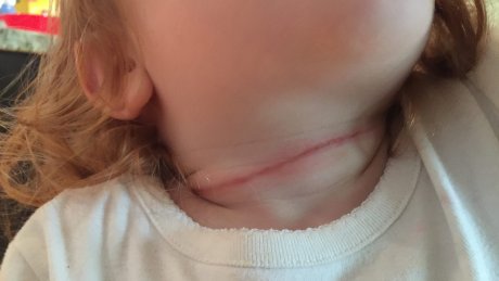 CBCToronto's tweet photo. After her toddler snagged her neck, a Toronto mother is calling out 'dangerous' retractable dog leashes https://t.co/c8qrgJFqiJ https://t.co/6m6WNXIoOv