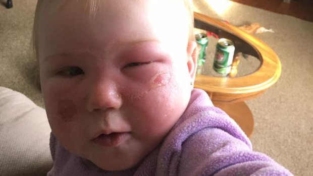 CTVNews's tweet photo. Parents allege sunscreen products caused severe reactions https://t.co/q42rsTPhKL https://t.co/IO9vGxtYaC