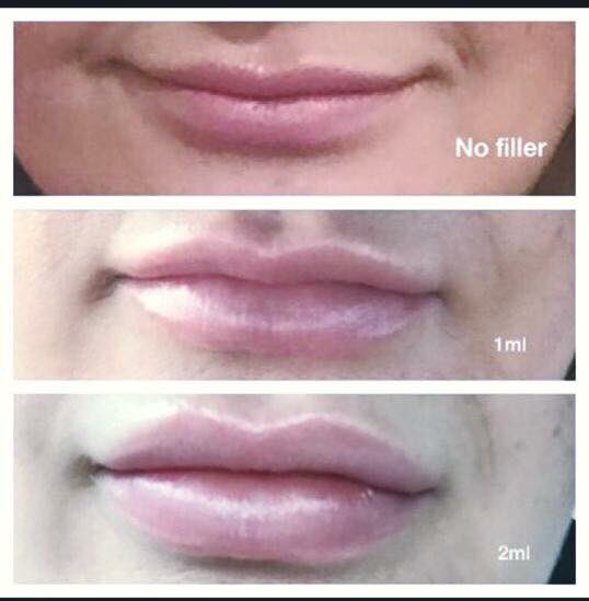 NWWstudios's tweet photo. #nwwstudios #lips #fillers https://t.co/Dt0aYsQTiw