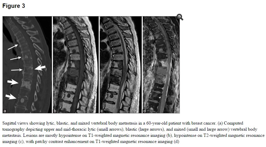 amandameyerphd's tweet photo. #Osteolytic &amp; #osteoblastic #spine #metastases from #breastcancer , #lungcancer , #ProstateCancer #RCC doi:  10.4103/2152-7806.182549 #free https://t.co/y3BNFh2e1s