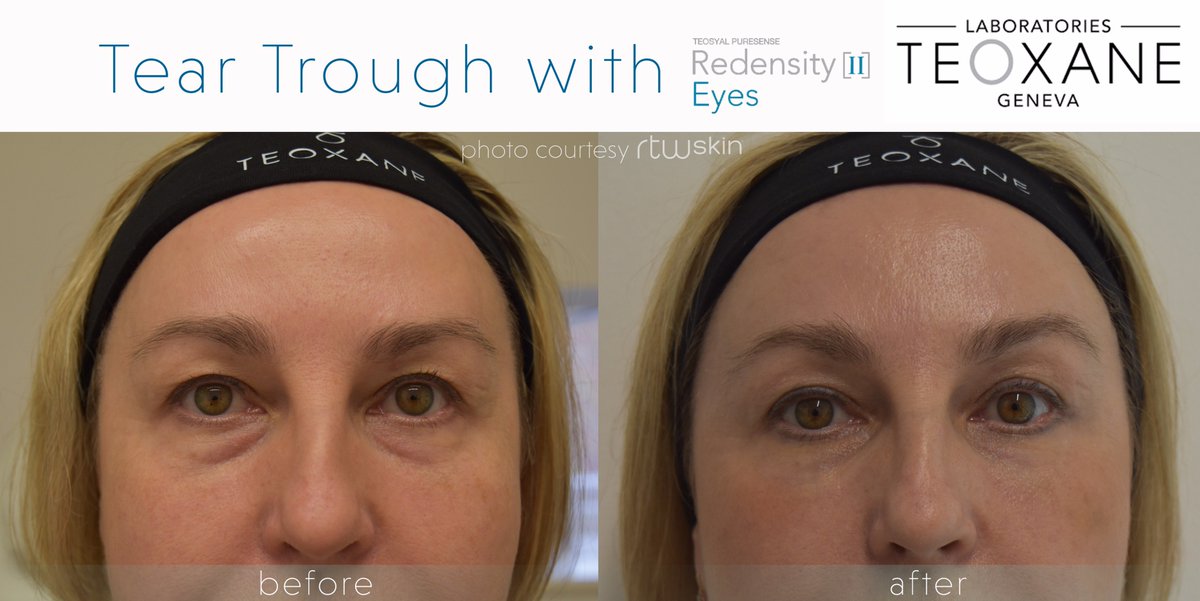 rtwskin's tweet photo. Another amazing result - Tear Trough with Redensity II
Aksana our nurse can help you with #tiredeyes.
#dermalfiller #teartrough #redensityII https://t.co/EfnzBQ5Suh