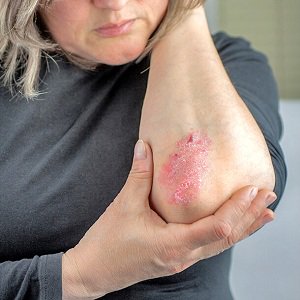 TheFrontDoor1's tweet photo. What You Should Know About Psoriasis  https://t.co/PFpnBuV602  #skincare  #psoriasis https://t.co/eo9OIMybUX