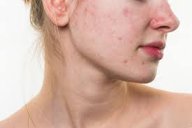TheFrontDoor1's tweet photo. Acne occurs when pores on the surface of the skin become clogged. https://t.co/Eiqb3SmwvV  #skincare  #acne https://t.co/IRAhPY1CTl