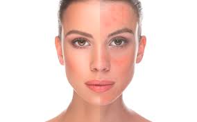TheFrontDoor1's tweet photo. The flushing and redness caused by this chronic facial skin condition is really distressing to sufferers. https://t.co/MTM4WlUIoR #skincare https://t.co/ZOvrvmpQA2